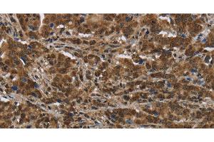 Immunohistochemistry of paraffin-embedded Human liver cancer tissue using PIP Polyclonal Antibody at dilution 1:50 (PIP anticorps)