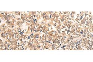 Immunohistochemistry of paraffin-embedded Human lung cancer tissue using CPS1 Polyclonal Antibody at dilution of 1:35(x200)