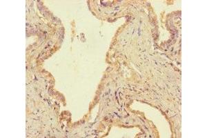 Immunohistochemistry of paraffin-embedded human prostate cancer using ABIN7174258 at dilution of 1:100