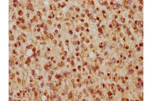 IHC image of nhibHU diluted at 1:5 and staining in paraffin-embedded human glioma cancer performed on a Leica BondTM system.