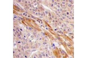 IHC analysis of FFPE human hepatocarcinoma tissue stained with PGK1 antibody