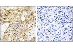 Immunohistochemistry analysis of paraffin-embedded human liver carcinoma tissue, using Collagen XVIII alpha1 Antibody. (COL18A1 anticorps  (AA 801-850))