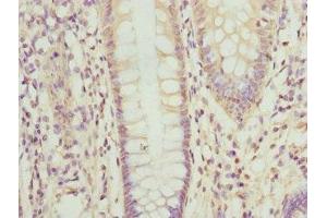 Immunohistochemistry of paraffin-embedded human colon cancer using ABIN7162208 at dilution of 1:100 (Oligophrenin 1 anticorps  (AA 1-270))