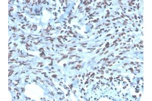 Formalin-fixed, paraffin-embedded human Renal Cell Carcinoma stained with PAX2 Mouse Monoclonal Antibody (PAX2/1104).