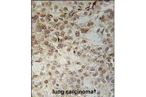 C14orf179 Antibody immunohistochemistry analysis in formalin fixed and paraffin embedded human lung carcinoma followed by peroxidase conjugation of the secondary antibody and DAB staining. (IFT43 anticorps  (AA 145-171))