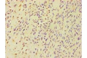 Immunohistochemistry of paraffin-embedded human breast cancer using ABIN7145262 at dilution of 1:100 (BSND anticorps  (AA 54-320))