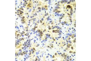 Immunohistochemistry of paraffin-embedded human lung cancer using SRSF1 Antibody (ABIN5970815) at dilution of 1/100 (40x lens). (SRSF1 anticorps)