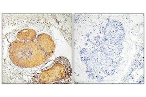Immunohistochemical analysis of paraffin-embedded human breast carcinoma tissue, using FADD (Phospho-Ser190) antibody (left)or the same antibody preincubated with blocking peptide (right).
