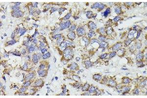 Immunohistochemistry of paraffin-embedded Human liver cancer using SUCLG2 Polyclonal Antibody at dilution of 1:100 (40x lens).