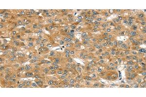 Immunohistochemistry of paraffin-embedded Human liver cancer tissue using RASSF9 Polyclonal Antibody at dilution 1:45 (RASSF9 anticorps)