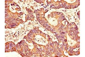 Immunohistochemistry of paraffin-embedded human colon cancer using ABIN7169453 at dilution of 1:100 (SH2D1B anticorps  (AA 1-77))
