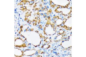 Immunohistochemistry of paraffin-embedded human thyroid cancer using PIST/GOPC Rabbit mAb (ABIN1678809, ABIN1678808, ABIN7101325 and ABIN7101326) at dilution of 1:100 (40x lens). (GOPC anticorps)