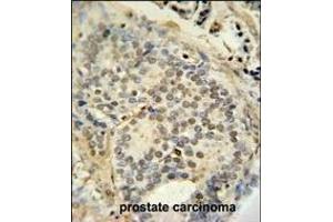 FUS antibody (C-term) (ABIN654146 and ABIN2844013) immunohistochemistry analysis in formalin fixed and paraffin embedded human prostate carcinoma followed by peroxidase conjugation of the secondary antibody and DAB staining.
