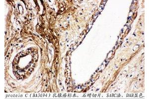 Anti-Protein C antibody, IHC(P) IHC(P): Human Mammary Cancer Tissue (PROC anticorps  (C-Term))