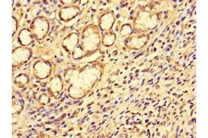 Immunohistochemistry of paraffin-embedded human gastric cancer using ABIN7146400 at dilution of 1:100