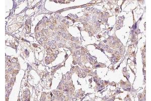 ABIN6267696 at 1/100 staining human Breast cancer tissue sections by IHC-P.