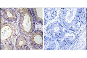 Immunohistochemistry analysis of paraffin-embedded human colon carcinoma tissue, using CBR3 Antibody. (CBR3 anticorps  (AA 151-200))
