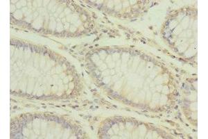 Immunohistochemistry of paraffin-embedded human colon cancer using ABIN7146772 at dilution of 1:100 (CPD anticorps  (AA 860-1100))