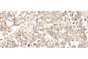 Immunohistochemistry of paraffin-embedded Human lung cancer tissue using RRP1 Polyclonal Antibody at dilution of 1:45(x200) (RRP1 anticorps)