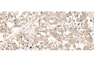 Immunohistochemistry of paraffin-embedded Human lung cancer tissue using RRP1 Polyclonal Antibody at dilution of 1:45(x200) (RRP1 anticorps)