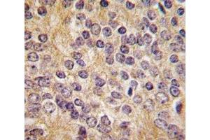 IHC analysis of FFPE human prostate carcinoma tissue stained with UPA antibody (PLAU anticorps  (AA 396-426))