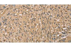 Immunohistochemistry of paraffin-embedded Human cervical cancer tissue using SETD2 Polyclonal Antibody at dilution 1:40