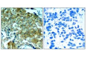 Immunohistochemical analysis of paraffin-embedded human breast carcinoma tissue, using (EGFR anticorps  (pTyr1172))