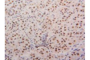 IHC-P analysis of Human Liver Cancer Tissue, with DAB staining. (HNRNPA2B1 anticorps  (AA 21-103))