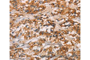 Immunohistochemistry of Human gastric cancer using CD80 Polyclonal Antibody at dilution of 1:50 (CD80 anticorps)