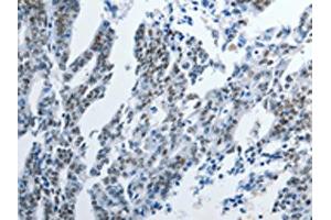 The image on the left is immunohistochemistry of paraffin-embedded Human gastric cancer tissue using ABIN7191895(PIWIL3 Antibody) at dilution 1/20, on the right is treated with synthetic peptide. (PIWIL3 anticorps)