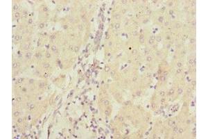 Immunohistochemistry of paraffin-embedded human liver cancer using ABIN7146746 at dilution of 1:100 (CBR4 anticorps  (AA 1-237))