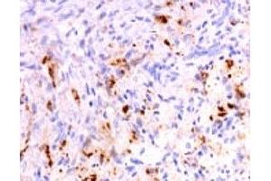 Formalin-fixed, paraffin-embedded human polyostotic sclerosing histiocytosis (Erdheim Chester disease) stained with anti-TNF alpha antibody (SPM543). (TNF alpha anticorps  (AA 115-130))