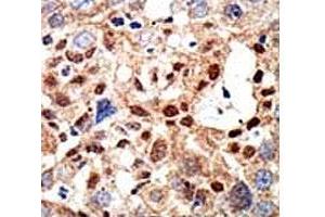 IHC analysis of FFPE human hepatocarcinoma tissue stained with the PML antibody