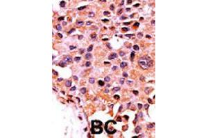 Formalin-fixed and paraffin-embedded human cancer tissue reacted with PPP3CA polyclonal antibody  , which was peroxidase-conjugated to the secondary antibody, followed by AEC staining. (PPP3CA anticorps  (N-Term))