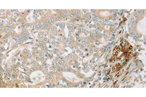 Immunohistochemistry of paraffin-embedded Human gastric cancer tissue using AMPK alpha1 Polyclonal Antibody at dilution 1:70 (PRKAA1 anticorps)