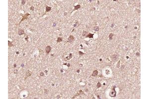 Paraformaldehyde-fixed, paraffin embedded human glioma, Antigen retrieval by boiling in sodium citrate buffer (pH6) for 15min, Block endogenous peroxidase by 3% hydrogen peroxide for 30 minutes,  Blocking buffer (normal goat serum) at 37°C for 20min, Antibody incubation with INPPL1(Tyr1135) Polyclonal Antibody (bs-3399R) at 1:400 overnight at 4°C, followed by a conjugated secondary and DAB staining.