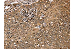 The image on the left is immunohistochemistry of paraffin-embedded Human cervical cancer tissue using ABIN7191664(NMT1 Antibody) at dilution 1/45, on the right is treated with synthetic peptide. (NMT1 anticorps)