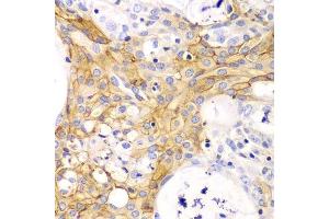 Immunohistochemistry of paraffin-embedded human oophoroma using ACTA2 antibody.
