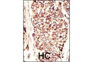 Formalin-fixed and paraffin-embedded human cancer tissue reacted with the primary antibody, which was peroxidase-conjugated to the secondary antibody, followed by AEC staining.