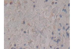 Detection of Rock2 in Human Stomach cancer Tissue using Polyclonal Antibody to Rho Associated Coiled Coil Containing Protein Kinase 2 (Rock2)