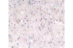 Detection of LRP4 in Human Glioma Tissue using Polyclonal Antibody to Low Density Lipoprotein Receptor Related Protein 4 (LRP4) (LRP4 anticorps  (AA 1610-1885))