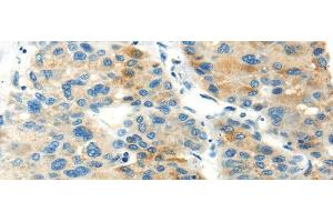 Immunohistochemistry of paraffin-embedded Human liver cancer using PDPN Polyclonal Antibody at dilution of 1/20 (Podoplanin anticorps)