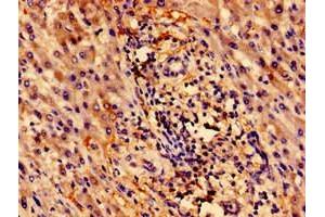 Immunohistochemistry of paraffin-embedded human liver cancer using ABIN7176118 at dilution of 1:100 (ZNF155 anticorps  (AA 1-538))