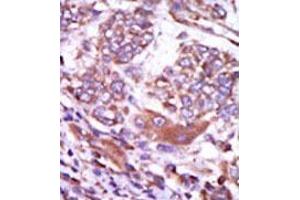 Formalin-fixed and paraffin-embedded human cancer tissue (hepatocarcinoma) reacted with the primary antibody, which was peroxidase-conjugated to the secondary antibody, followed by AEC staining. (CAMK2D anticorps  (C-Term))