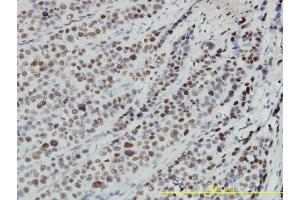 Immunoperoxidase of monoclonal antibody to RBBP4 on formalin-fixed paraffin-embedded human transitional cell carcinoma tissue.