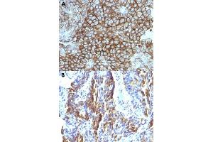 Immunohistochemical staining (Formalin-fixed paraffin-embedded sections) of (A) human melanoma and (B) human tongue with Melanoma monoclonal antibody, clone KBA. (Melanoma anticorps)