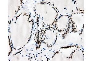 Immunohistochemical staining of paraffin-embedded Adenocarcinoma of breast tissue using anti-CAMK1D mouse monoclonal antibody. (CAMK1D anticorps)