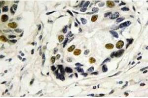 Immunohistochemistry (IHC) analyzes of p53 antibody in paraffin-embedded human breast carcinoma tissue. (p53 anticorps)