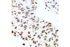 Immunohistochemistry of paraffin-embedded human prostate cancer using SSB antibody at dilution of 1:100 (40x lens). (SSB anticorps)