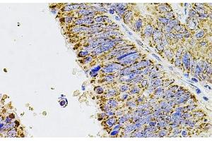 Immunohistochemistry of paraffin-embedded Human colon carcinoma using ALDH1A1 Polyclonal Antibody at dilution of 1:100 (40x lens).